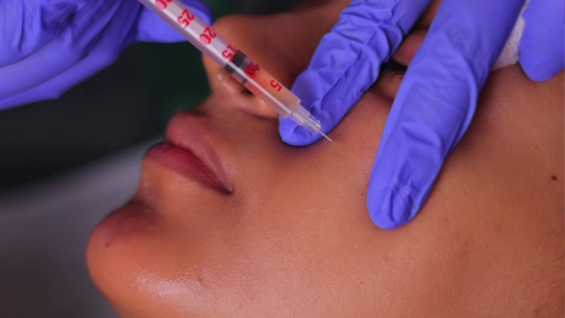 Bio filler injection for natural facial volume restoration