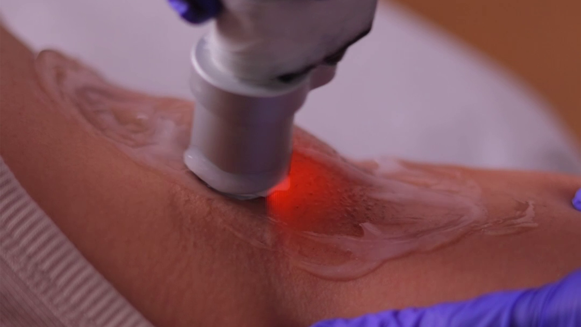 Underarm pigmentation treatment using laser device for skin tone improvement
