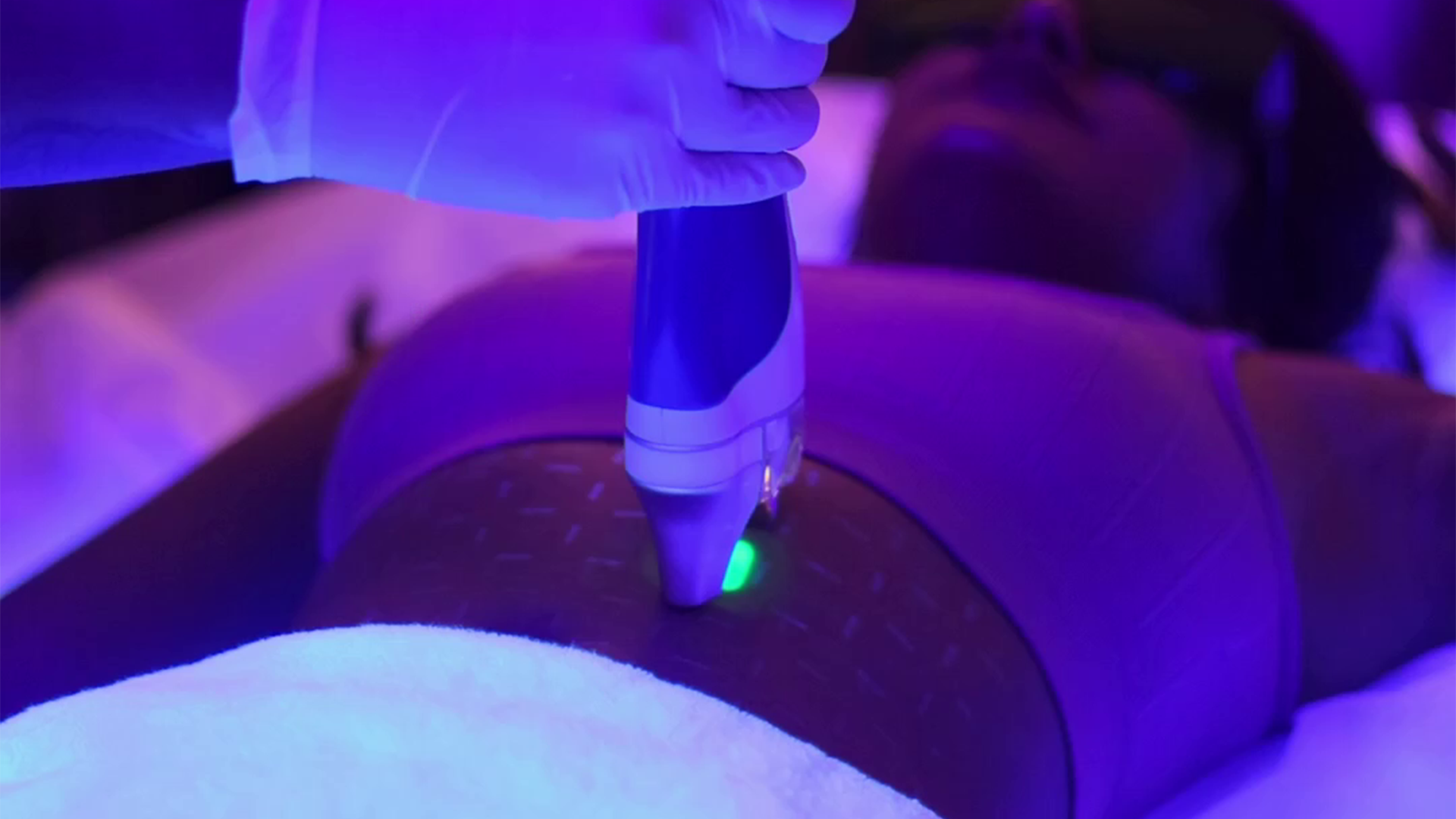 Laser hair reduction treatment using advanced laser device