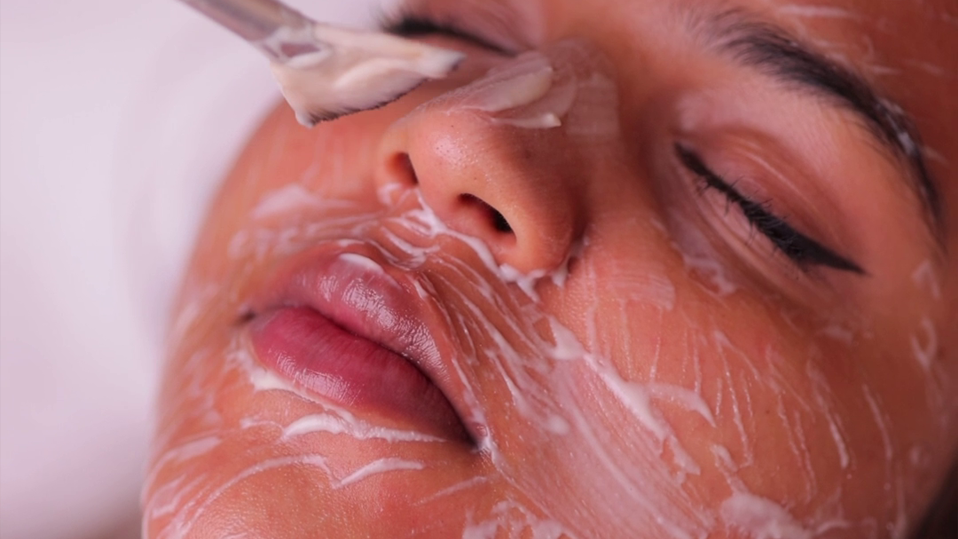 Melasma skin care treatment with cream spread across the face