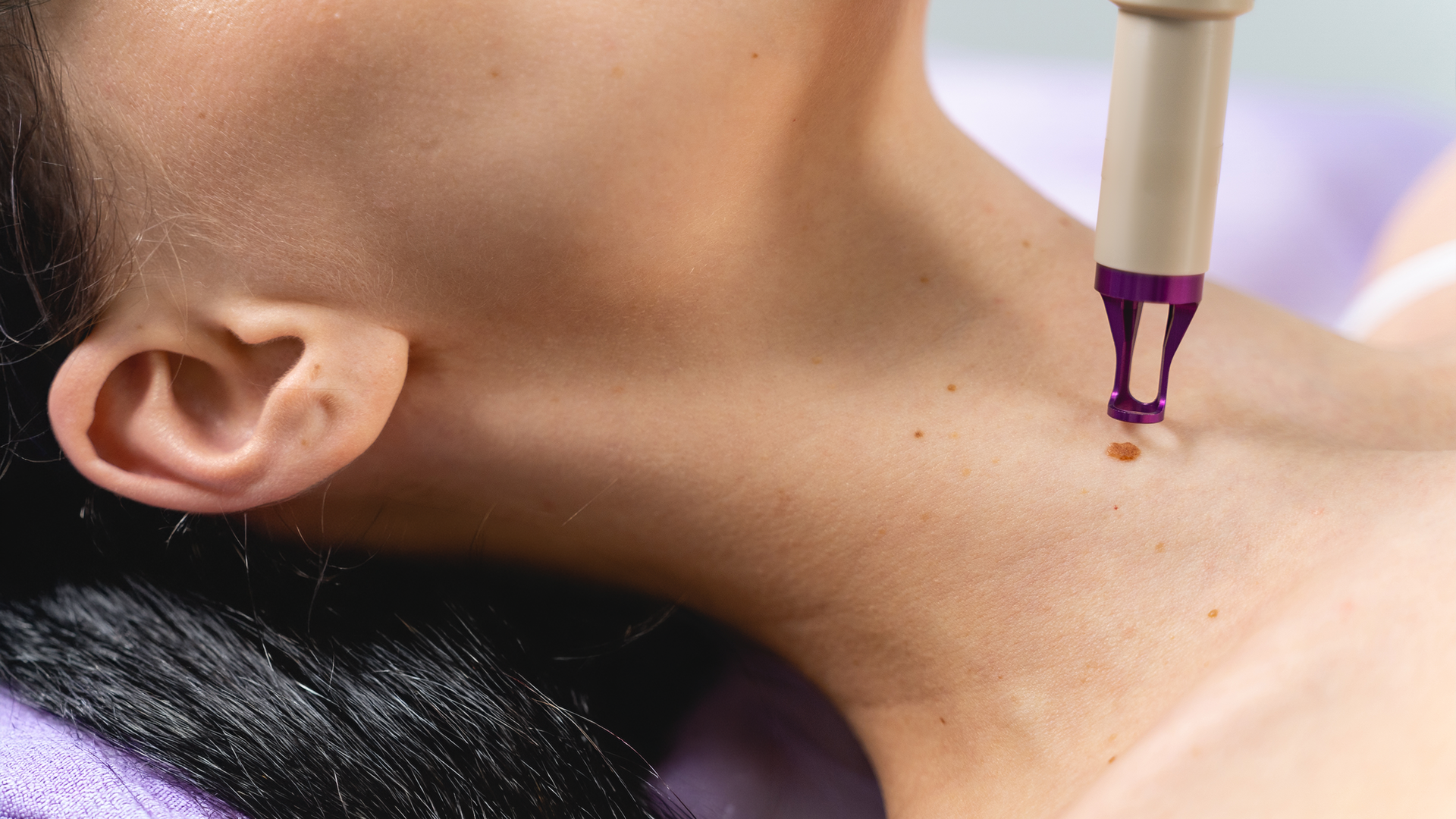 Skin tag on neck being treated with targeted removal procedure