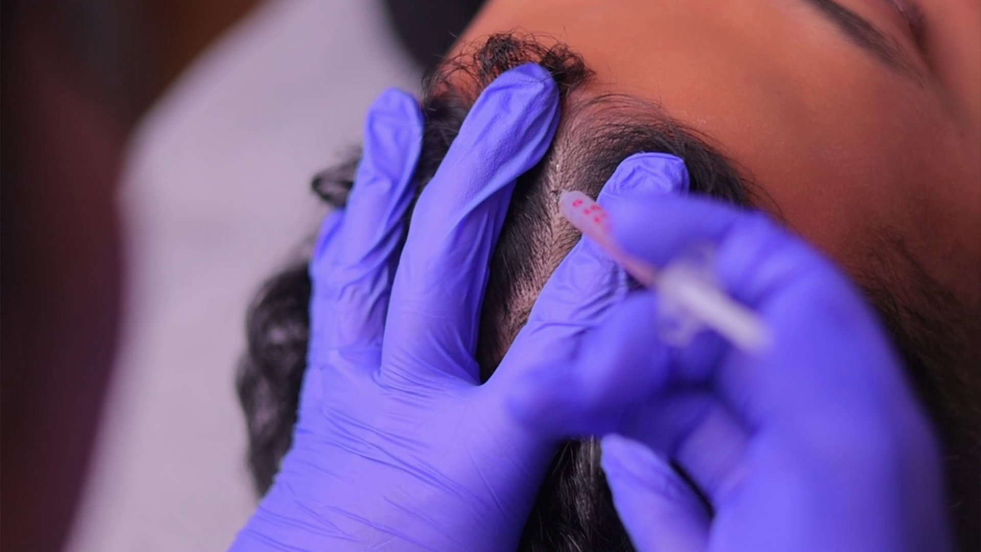 PRF hair treatment with scalp injection for hair regrowth