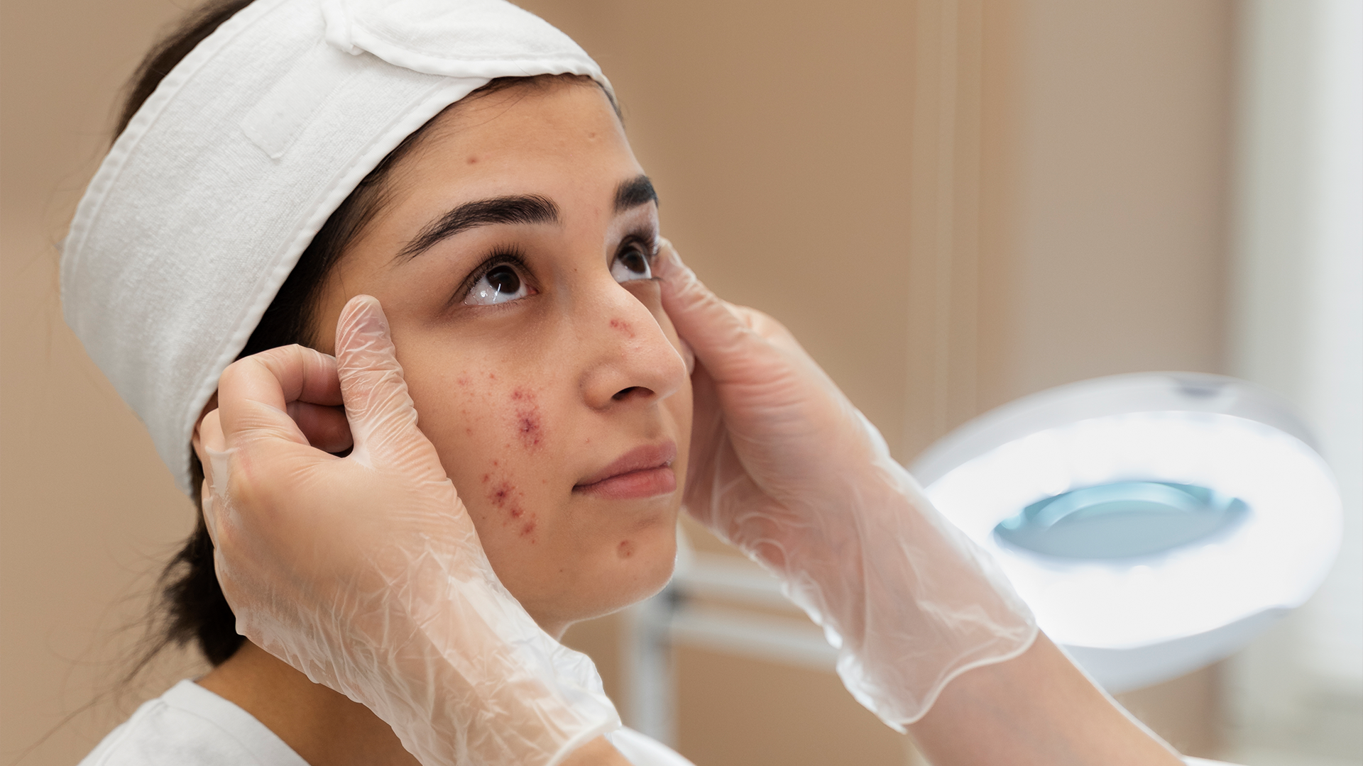 Pimple scar removal treatment examined by a specialist