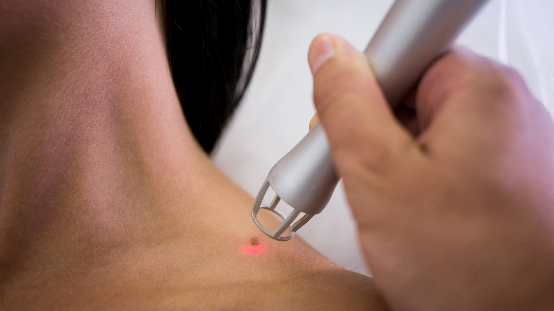 Wart removal on neck using precision laser device