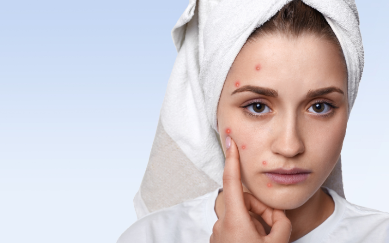 What is Acne Marks on Face? Understand Type of Acne, and How to Get Rid of Acne Scars
