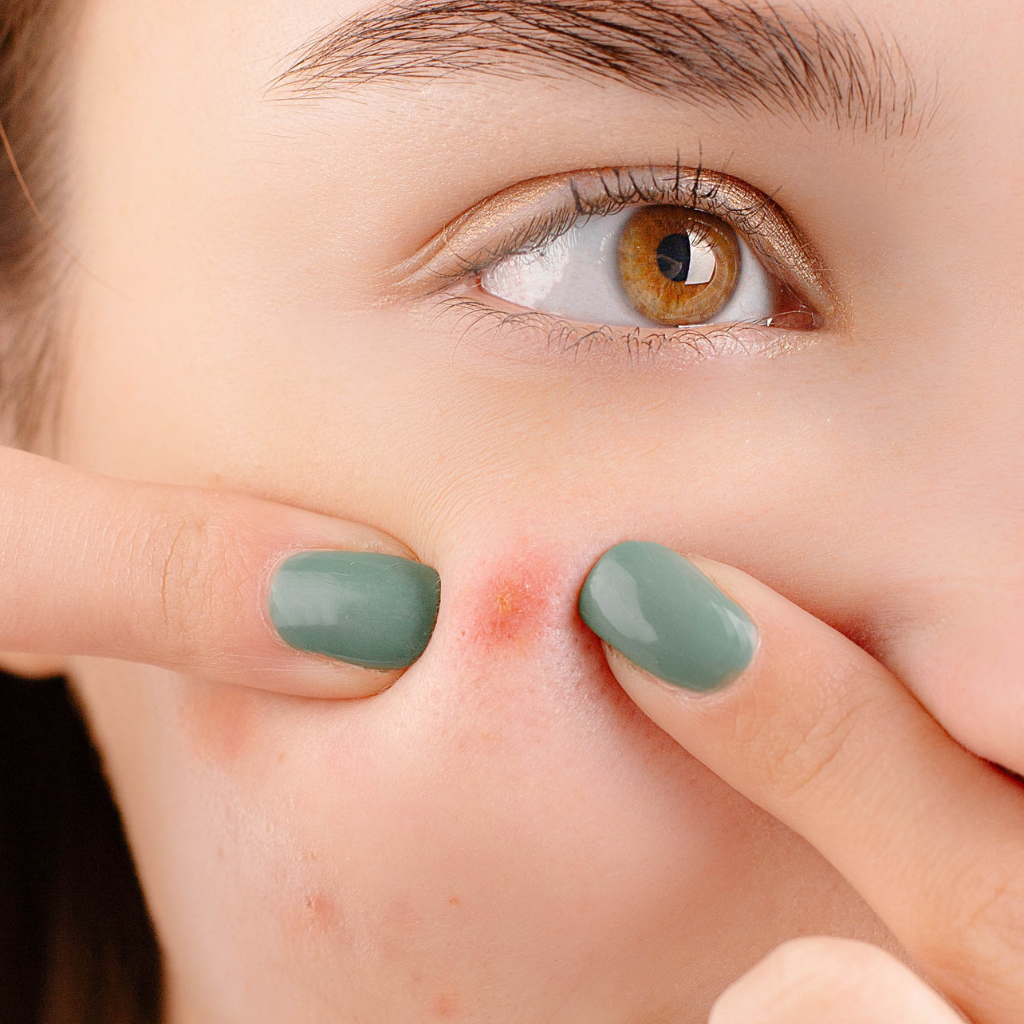 What Is Pimple on the Face? Causes, Types &amp; Effective Treatments