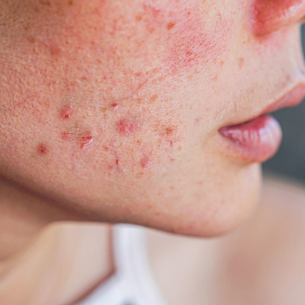 How Long Does Postpartum Acne Last and What Treatment Options Help?