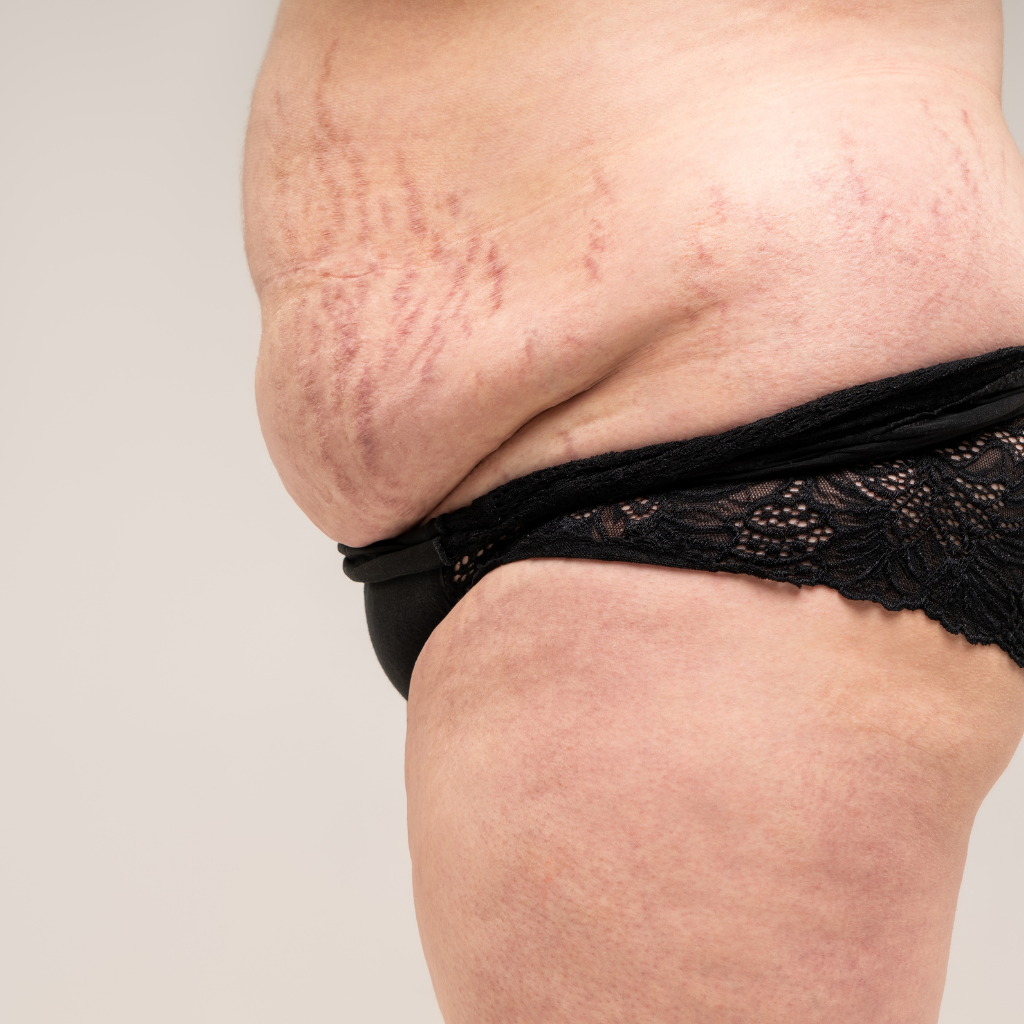 How to Treat Red Stretch Marks: Causes and Treatment for Smoother Skin